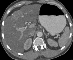 Cholangiocarcinoma With Capsular Retraction - CTisus CT Scan