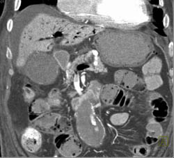 Hepatic Ischema Case Study