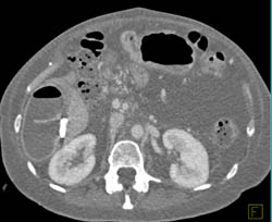 Liver Abscess - CTisus CT Scan