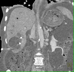 Liver Abscess - CTisus CT Scan