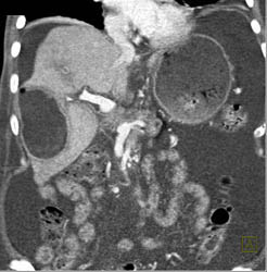 Liver Abscess - CTisus CT Scan