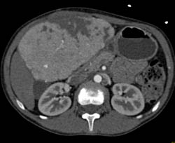 Focal Nodular Hyperplasia (FNH) S/P Embolization - CTisus CT Scan