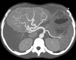 Focal Nodular Hyperplasia (FNH) at Presentation - CTisus CT Scan