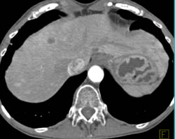 Liver Metastases With Flow Related Change Due to Pancreatic Cancer - CTisus CT Scan