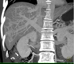 Unusual Liver Collaterals - CTisus CT Scan