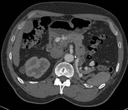 Multiple Mesenteric Artery Aneurysms Including Hepatic Artery Aneurysms - CTisus CT Scan