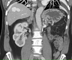 Hepatic Arteriovenous Malformation (AVM) - Liver Case Studies - CTisus