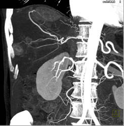 Hepatoma - CTisus CT Scan