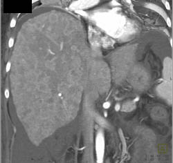 Hepatoma - CTisus CT Scan