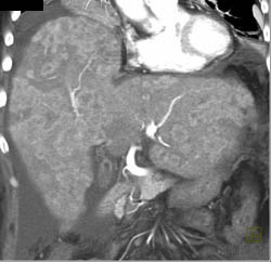 Hepatoma - CTisus CT Scan