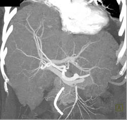 Tumor Infiltrates the Liver - CTisus CT Scan