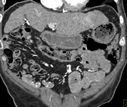 Cirrhosis W/o HCC - CTisus CT Scan