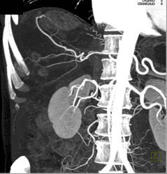 Stretched Liver Vessels - CTisus CT Scan