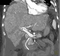 Liver Metastases Versus Hepatocellular Carcinoma (HCC). This Was An Unusual Multifocal HCC - CTisus CT Scan