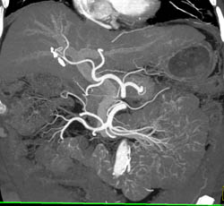 Cirrhosis - CTisus CT Scan