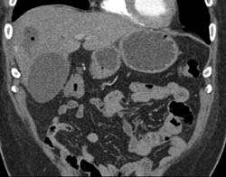 Liver Abscess - CTisus CT Scan