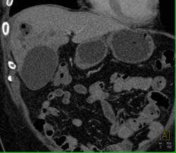 Liver Abscess - CTisus CT Scan