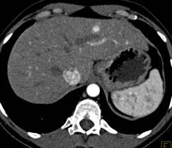 Islet Cell Metastases to the Liver With Vascular Metastases - CTisus CT Scan