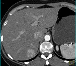 Focal Nodular Hyperplasia (FNH) - CTisus CT Scan