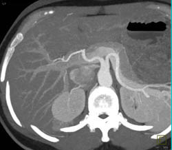 Focal Nodular Hyperplasia (FNH) - CTisus CT Scan