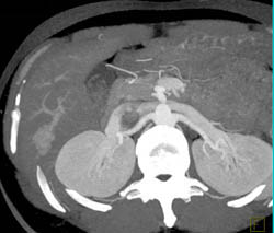 Focal Nodular Hyperplasia (FNH) - CTisus CT Scan