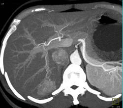 Focal Nodular Hyperplasia (FNH) - CTisus CT Scan