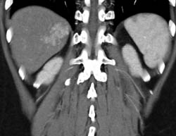 Focal Nodular Hyperplasia (FNH) - CTisus CT Scan