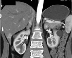 Focal Nodular Hyperplasia (FNH) - CTisus CT Scan