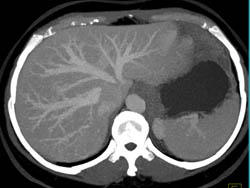 Focal Nodular Hyperplasia (FNH) - CTisus CT Scan