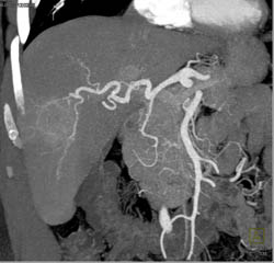 Multifocal Hepatoma - CTisus CT Scan