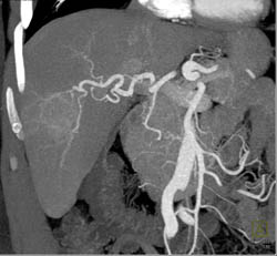 Multifocal Hepatoma - CTisus CT Scan