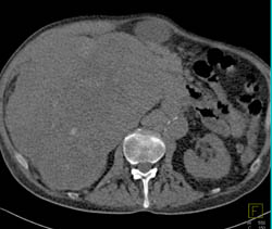 Hepatoma- Multiple Phases - CTisus CT Scan