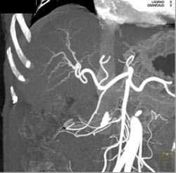 Cirrhosis - CTisus CT Scan