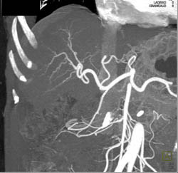 Cirrhosis - CTisus CT Scan