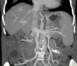 Cirrhosis - CTisus CT Scan