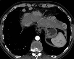 Paracardiac Nodes With Implants on Liver and Diaphragm- Carcinoid Tumor - CTisus CT Scan