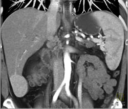 Focal Nodular Hyperplasia (FNH) - CTisus CT Scan