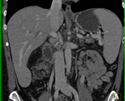 Focal Nodular Hyperplasia (FNH) - CTisus CT Scan