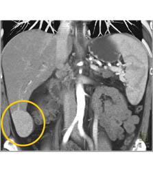 Focal Nodular Hyperplasia (FNH) - CTisus CT Scan