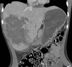 Giant Cavernous Hemangioma - CTisus CT Scan