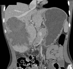 Giant Cavernous Hemangioma - CTisus CT Scan