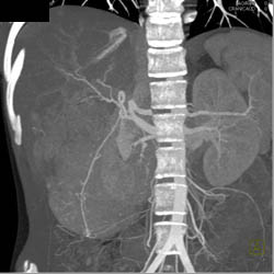 Giant Cavernous Hemangioma - CTisus CT Scan