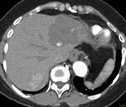 Focal Nodular Hyperplasia (FNH)- Right Lobe- and Hemangioma- Left Lobe - CTisus CT Scan