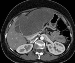 Focal Nodular Hyperplasia (FNH) - CTisus CT Scan