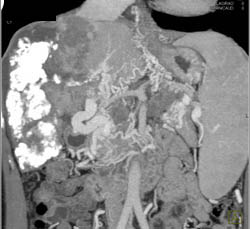 Hepatoma S/P Tace With Huge Varices - CTisus CT Scan