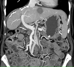 Liver S/P Resection With Negative Images - CTisus CT Scan