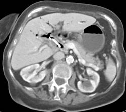 Common Duct Cholangiocarcinoma - CTisus CT Scan