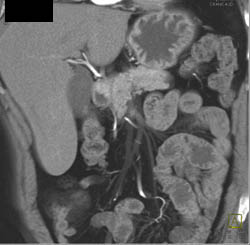 Ampullary Tumor That Encases - CTisus CT Scan