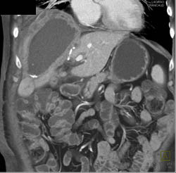 Subhepatic Abscess - CTisus CT Scan