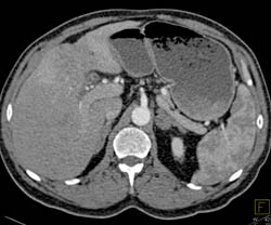 Hepatoma - CTisus CT Scan